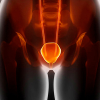 Гиперактивный мочевой пузырь