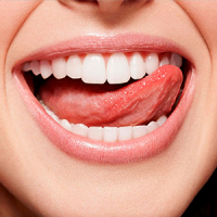 Что такое красный плоский лишай полости рта?